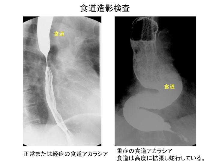 食道アカラシア